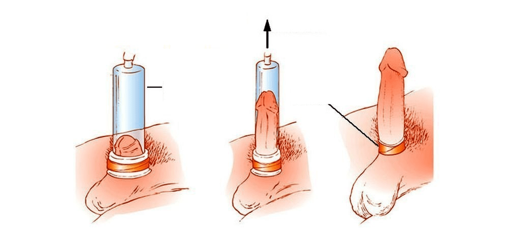как работи вакуумна помпа за уголемяване на пениса