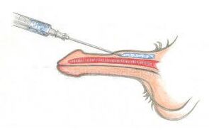 Инжектиране на хиалуронова киселина под кожата, за да стане пенисът по -дебел