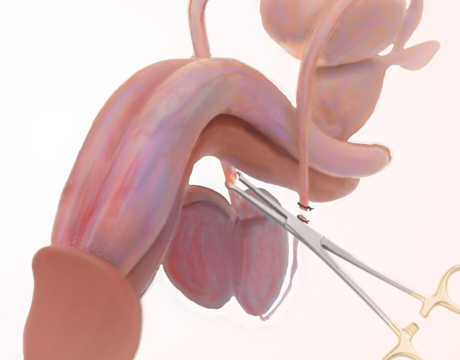 лигаментотомия за уголемяване на пениса