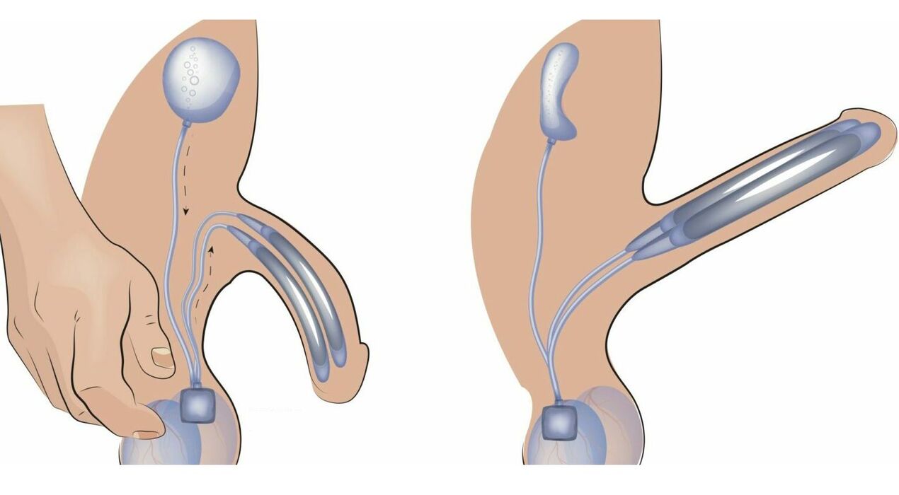 пенисна протеза за уголемяване на пениса